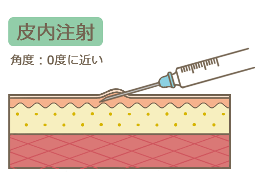 皮内注射
