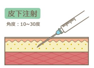 注射のコツ 注射の種類